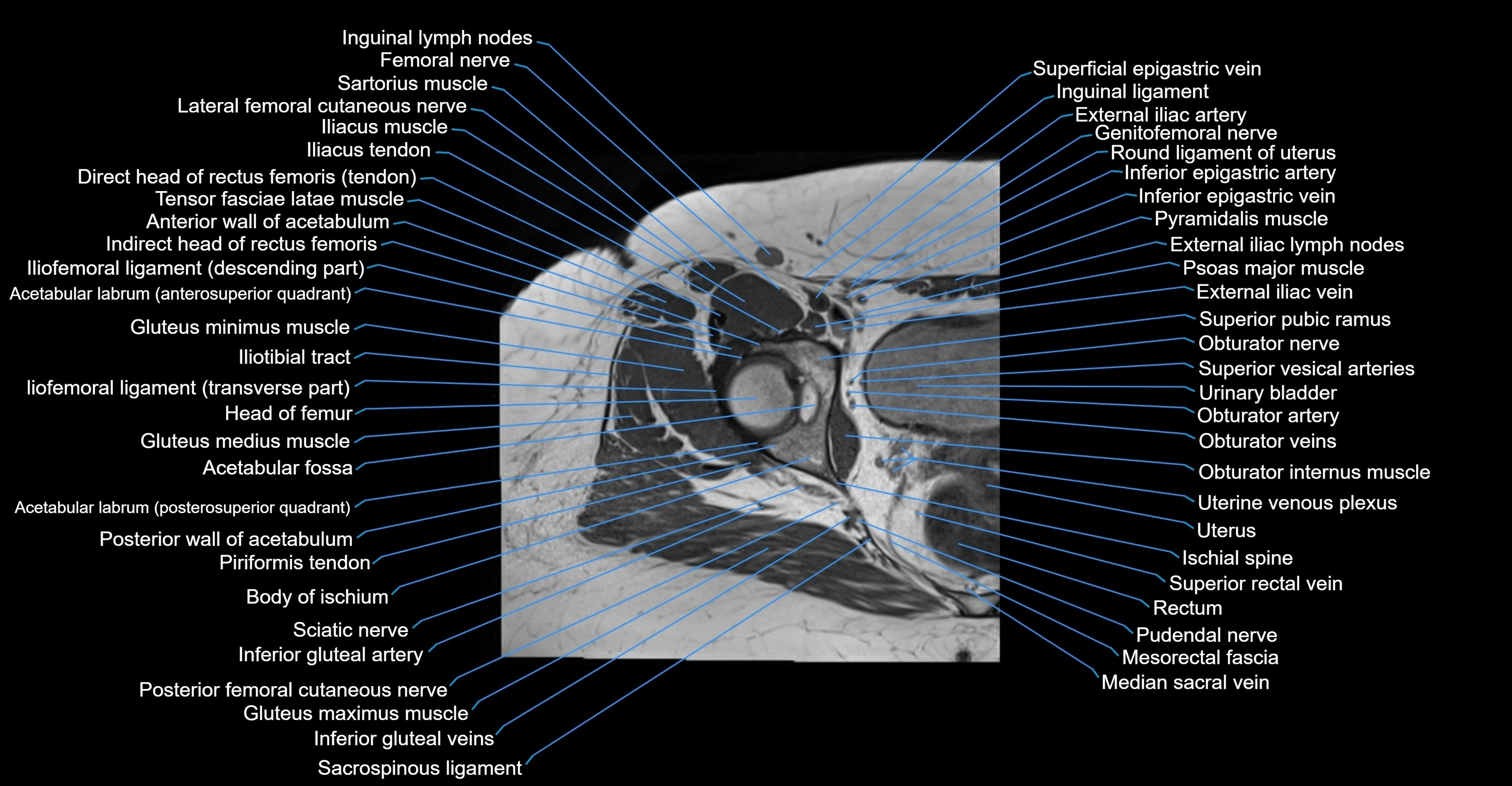 MRI hip axial cross sectional anatomy 3T 3D  radiology  anatomy image-img-00001-00030.webp